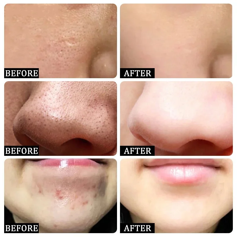 Salicylic Acid Pore Clearing C - Korean Skincare Routine บทวิจารณ์และราคา